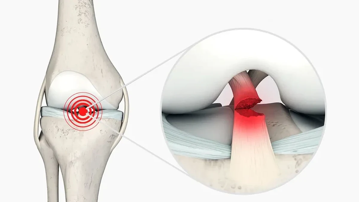 Ilustração do interior do joelho mostrando o ligamento cruzado anterior rompido