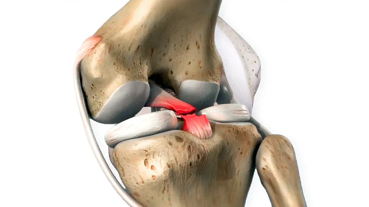 Ilustração anatômica do joelho destacando o ligamento cruzado posterior